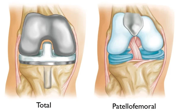 Arthroscopic surgery of the Patello femoral Joint