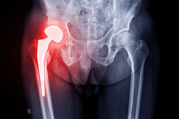 Revision Hip replacement