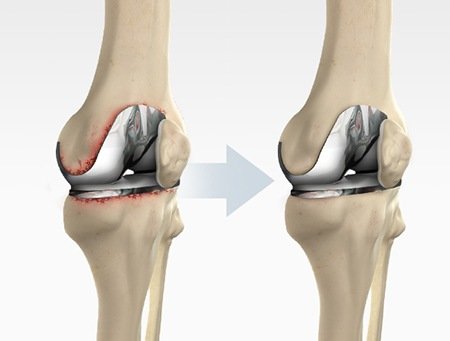 Revision Knee Replacement