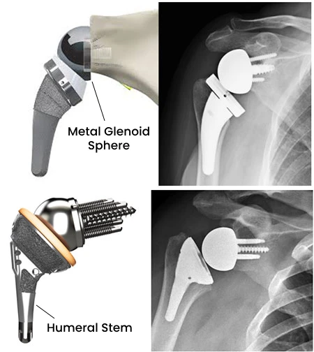 Reverse Shoulder Replacement Be Performed