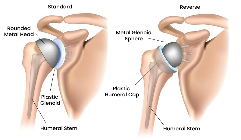 Reverse Shoulder Replacement results