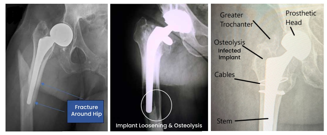 Arthroplasty