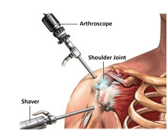 Arthroscopic Capsular Release