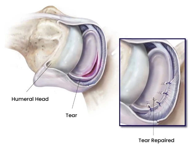 Arthroscopic Labral Repair Procedure