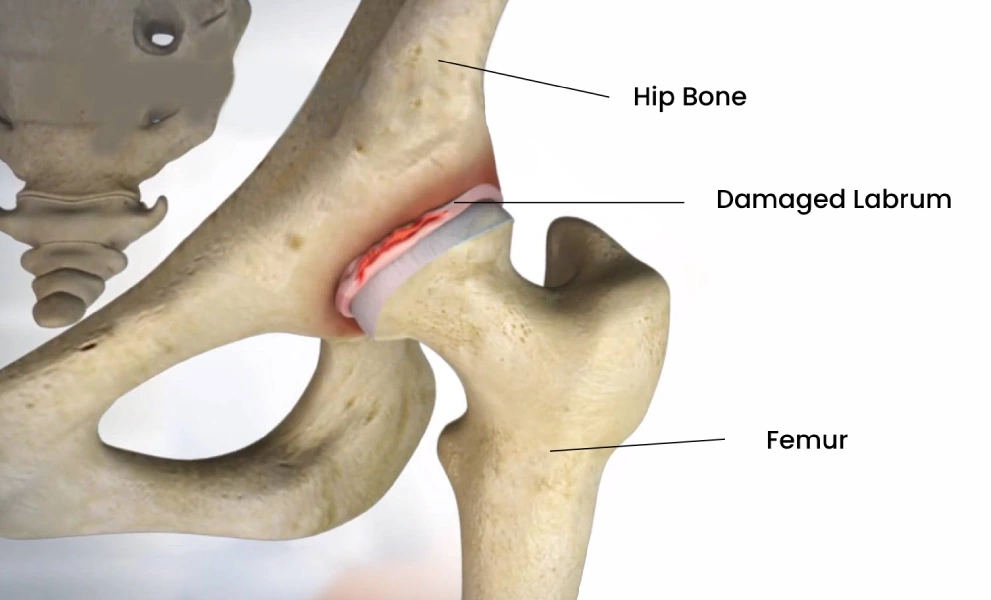 Arthroscopic Labral repair of Hip joint