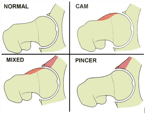 Types of Femoroacetabular Impingement