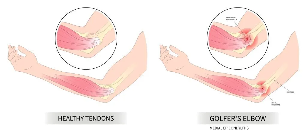 Golders Elbow Anatomy