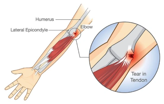 Golfers elbow