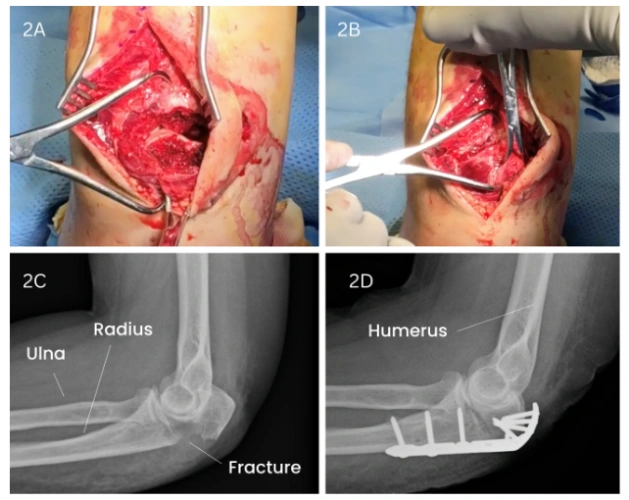 How Is Elbow Fracture Surgery Performed