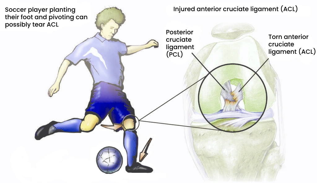 Injured anterior cruciate ligament (ACL)