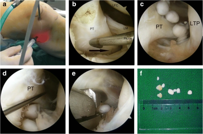 Loose Bodies Removal Surgery Performed