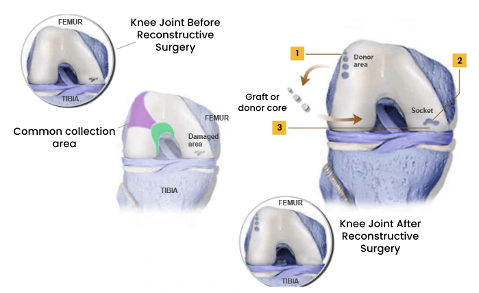 OATS Procedure Performed