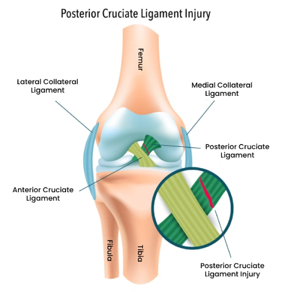 Posterior Cruciate ligament injury