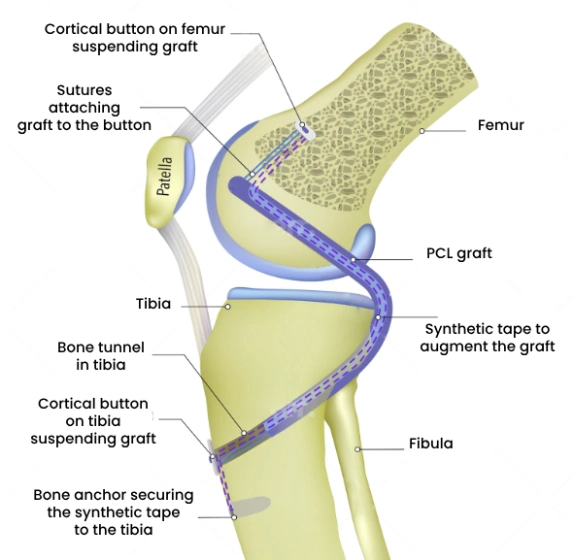 Posterior cruciate ligament (PCL) reconstruction