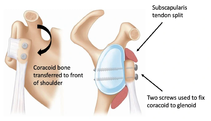 Principles of the latarjet procedure