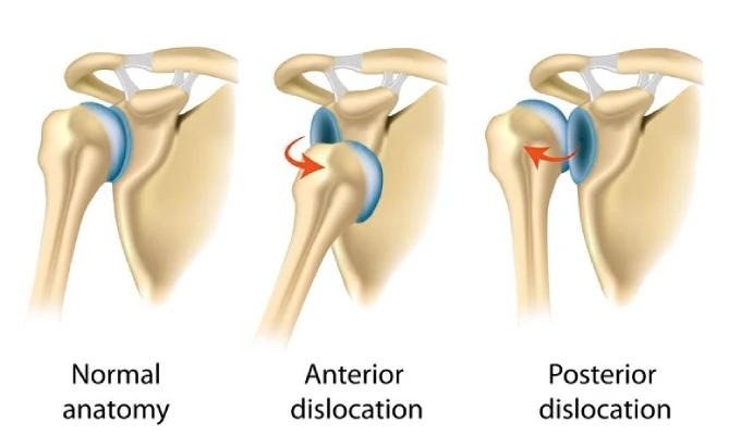 Shoulder Joint Stabilization