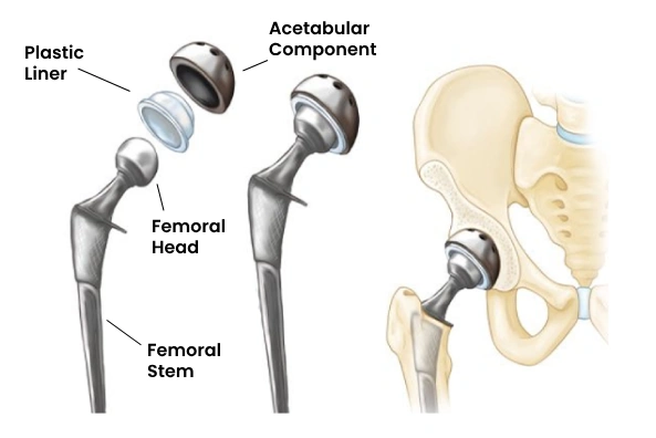 SuperPATH Hip replacement
