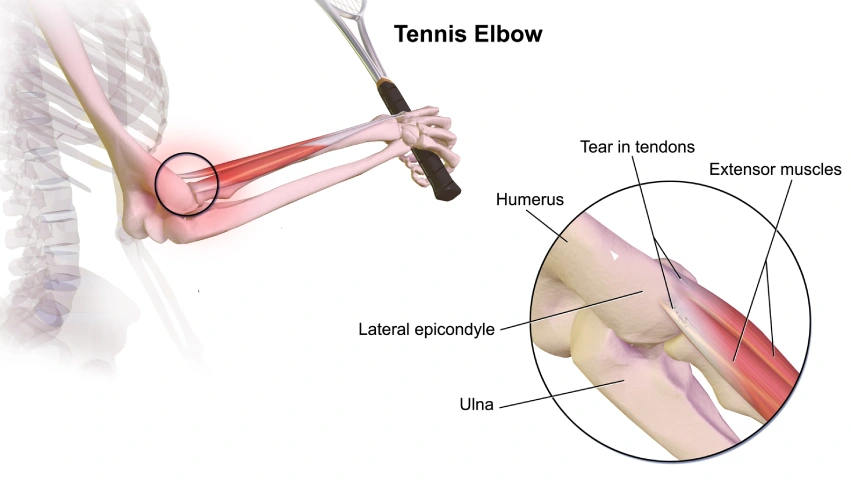 Tennis Elbow injury treatment