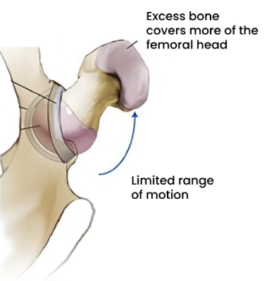 Treating Femoroacetabular Impingement