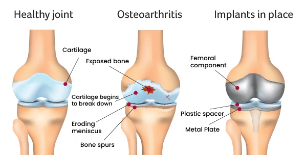 What Happens During Knee Joint Replacement Surgery