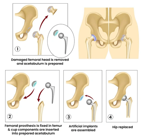 What Happens During Total Hip Replacement Surgery