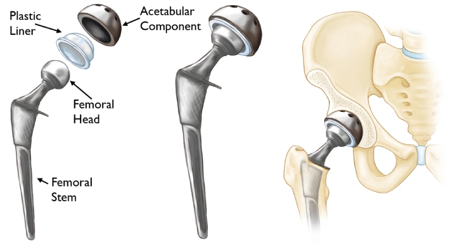 What Is Total Hip Replacement Surgery