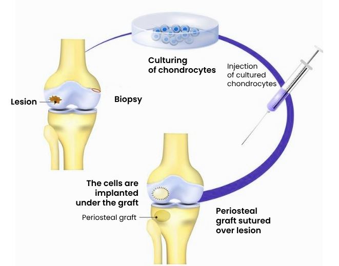 acl procedure performed