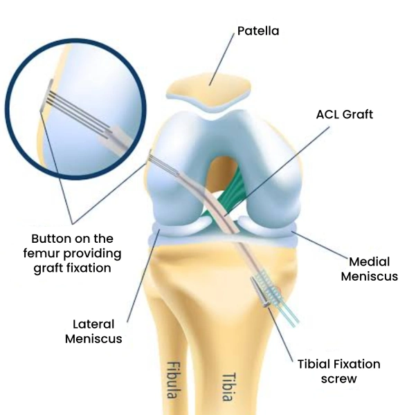 acl reconstruction