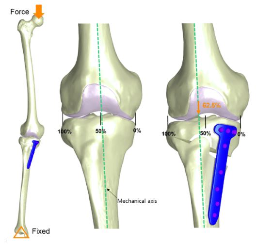 After alignment correction osteotomy