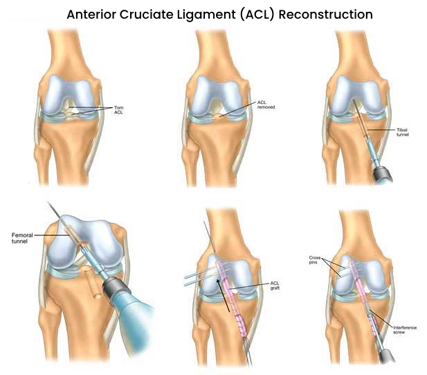 anterior cruciate ligament (ACL) reconstruction