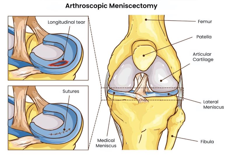 arthroscopic meniscectomy