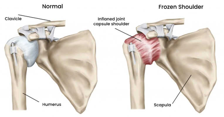 Causes Frozen Shoulder