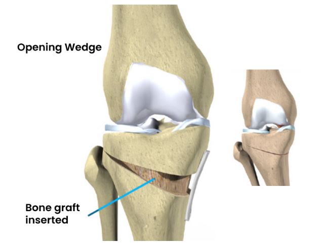 correction osteotomy performed