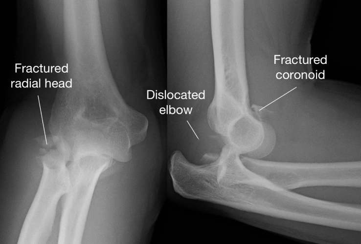 elbow fracture surgery