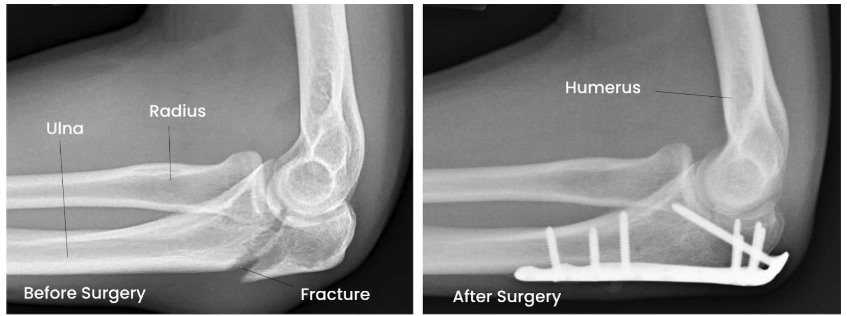 Elbow fracture treatment results