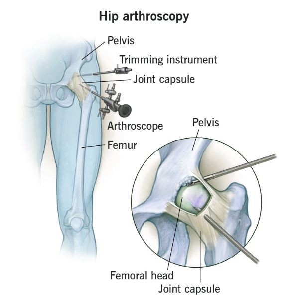 HIP Arthroscopy