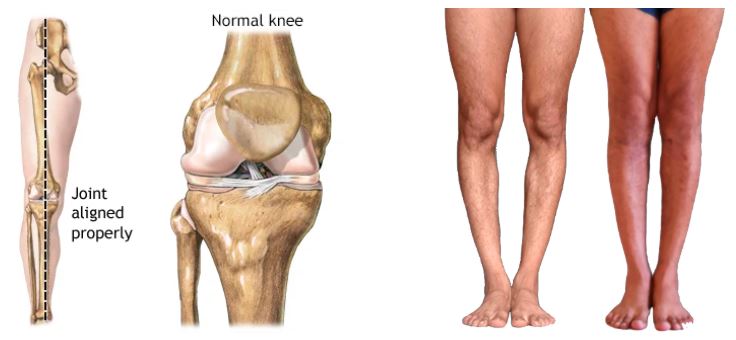 knee alignment