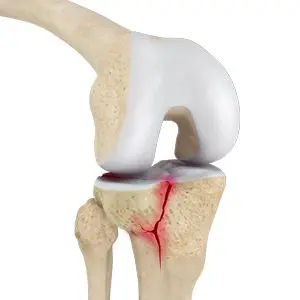 knee fracture surgery