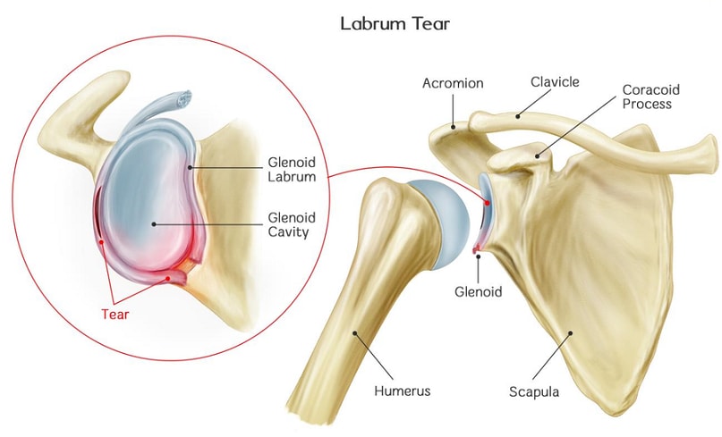 Labrum Tear