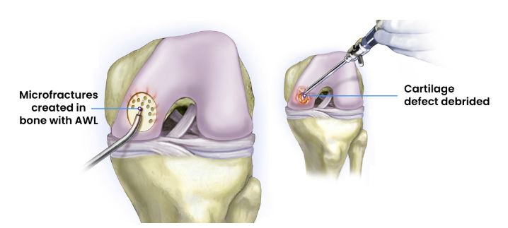 Microfracture surgery performed