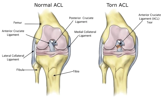 normal acl torn acl