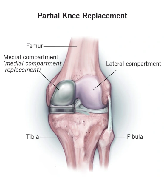 Partial knee replacement