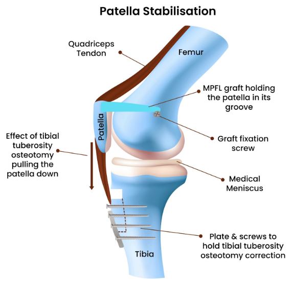 Patella Stabilisation