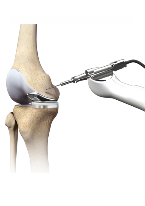 Robotic joint replacement surgery