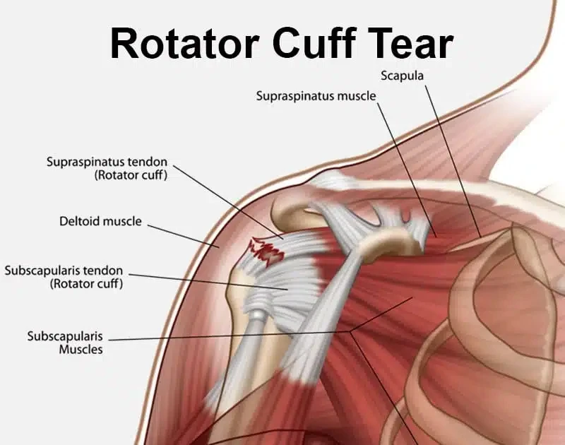 rotator-cuff-tear