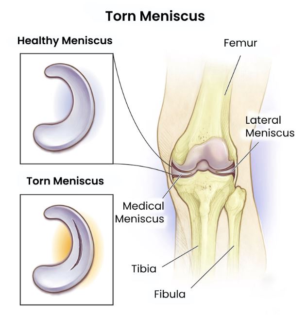 torn-meniscus