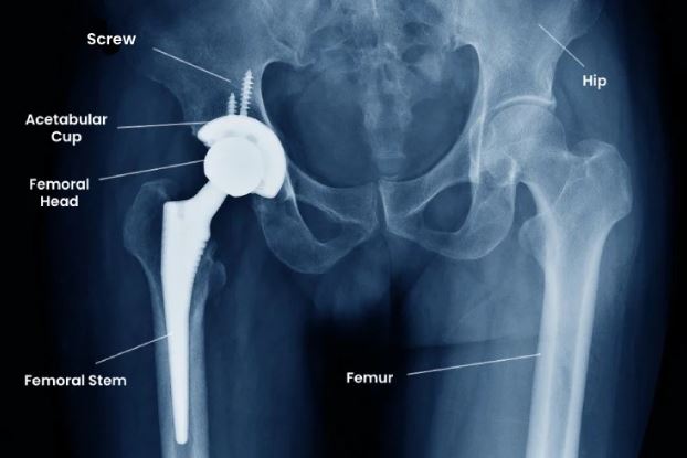 Total hip replacement surgery