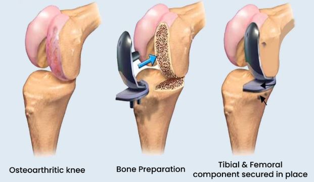 Unicondylar knee replacement surgery