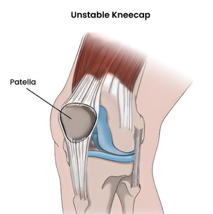 Unstable Kneecap