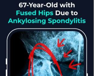 Hip Surgery Success Story